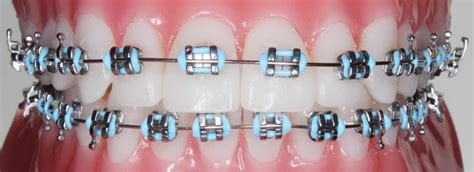 are there flash free metal brackets orthodontics|orthodontic adhesive.